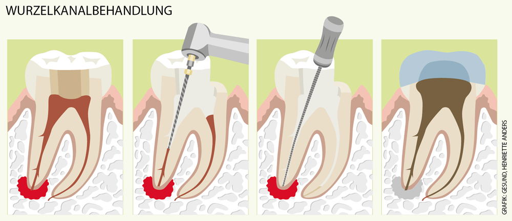 wurzelbehandlung endodontie wurzelkanalbehandlung rödermark zahnarzt